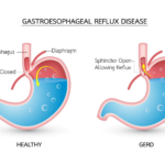 Pentingnya Edukasi Kesehatan Lambung dan Klarifikasi Informasi Terkait Penyakit GERD